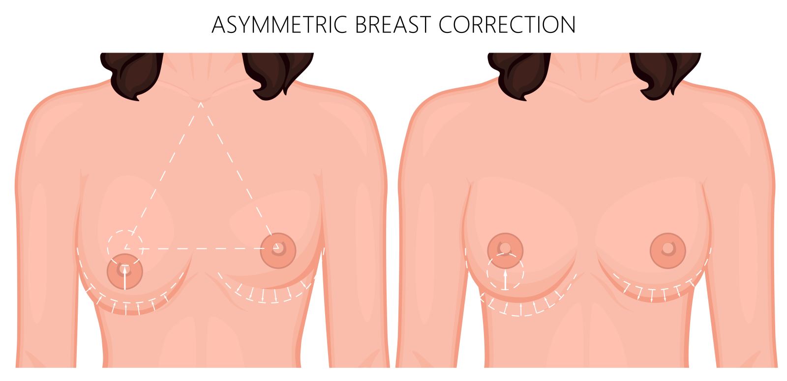 Revisions of breast reconstructions